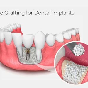 What Is Bone Grafting? A Complete Guide for Dental Patients