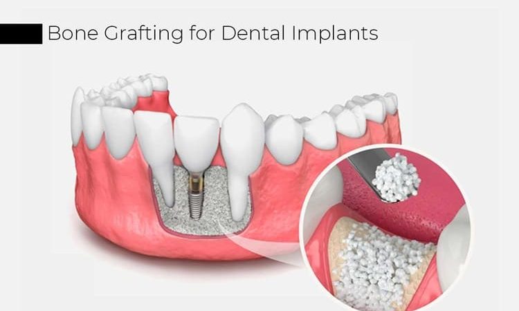 What Is Bone Grafting? A Complete Guide for Dental Patients