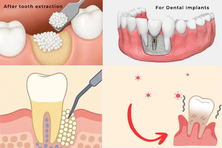 What Is Bone Grafting? A Complete Guide for Dental Patients