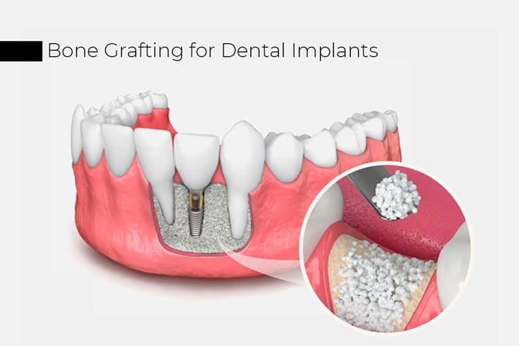 What Is Bone Grafting? A Complete Guide for Dental Patients