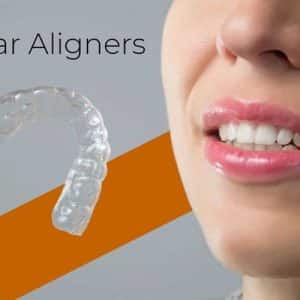 Trusted Clear Aligner Treatment in A S Rao Nagar