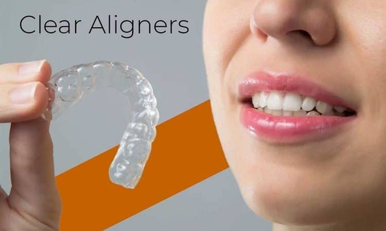 Trusted Clear Aligner Treatment in A S Rao Nagar