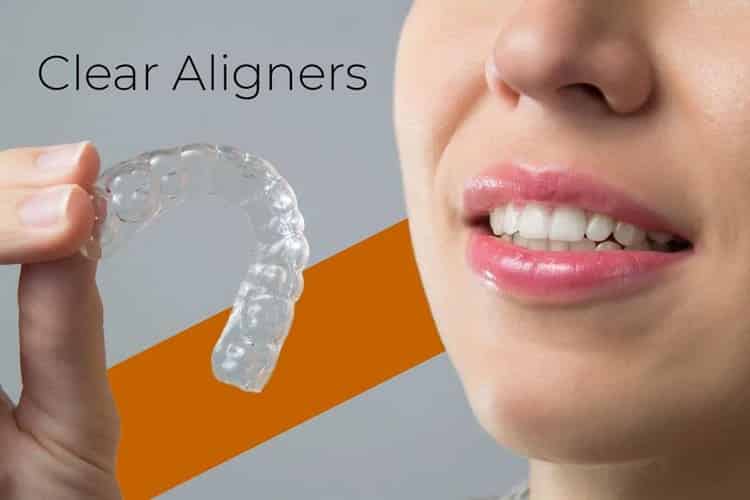 Trusted Clear Aligner Treatment in A S Rao Nagar