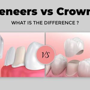 Dental Veneers vs  Dental Crowns: Which Is Better for Smile Correction?