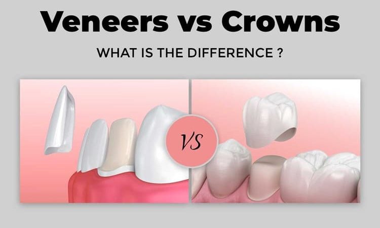 Dental Veneers vs  Dental Crowns: Which Is Better for Smile Correction?