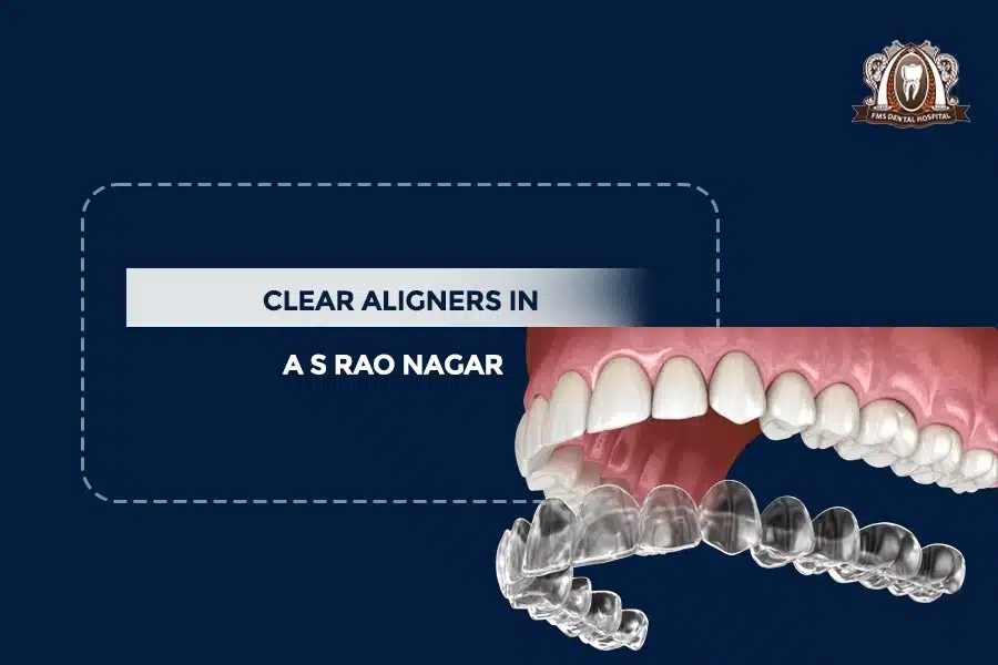 clear aligners