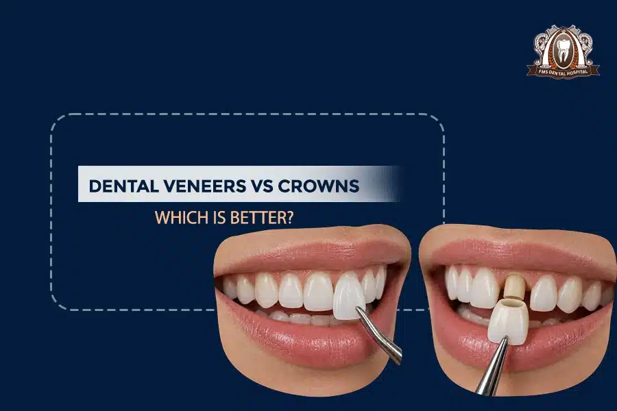 veneers vs crowns