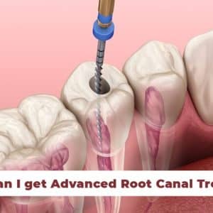 Where can I get Advanced Root Canal Treatment?
