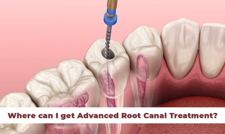Where can I get Advanced Root Canal Treatment?