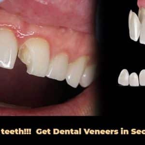 Chipped off teeth!!!  Get Dental veneers in Secunderabad