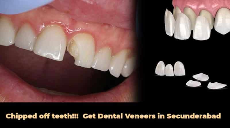 Chipped off teeth!!!  Get Dental veneers in Secunderabad