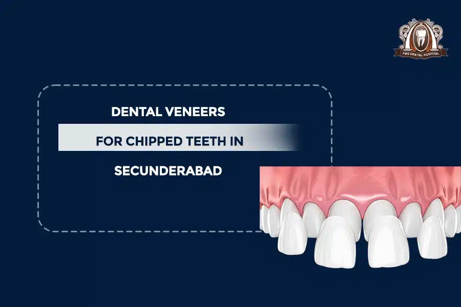 DENTAL VEENERS
