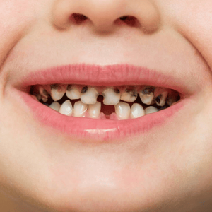 Early Childhood Caries — A Complete Guide for Parents
