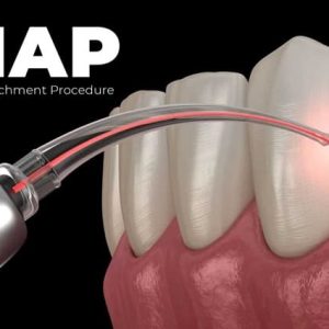 A Gentle Light for Healing Gums: Understanding LANAP Treatment at FMS Dental
