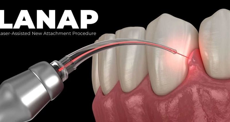 A Gentle Light for Healing Gums: Understanding LANAP Treatment at FMS Dental