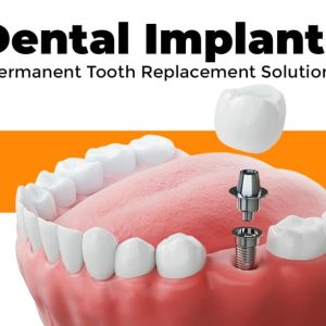 Permanent Tooth Replacement Solutions in Kondapur