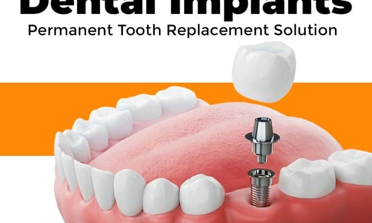 Permanent Tooth Replacement Solutions in Kondapur