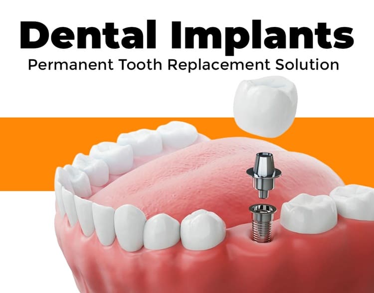 Permanent Tooth Replacement Solutions in Kondapur