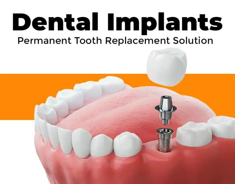 Permanent Tooth Replacement Solutions in Kondapur