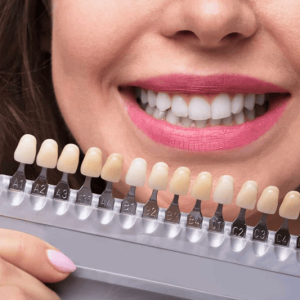 Expert Teeth Whitening Treatment in Dilsukhnagar