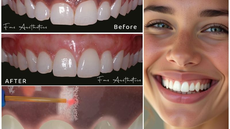 Unveil a Brighter Smile: The Magic of Gum Depigmentation