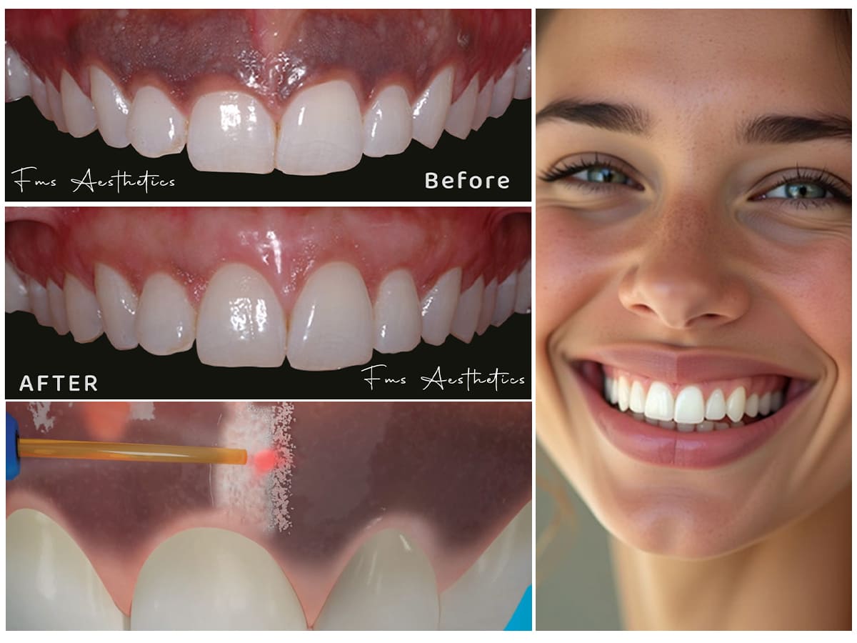 Unveil a Brighter Smile: The Magic of Gum Depigmentation
