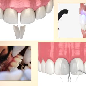 Is Dental Bonding an Affordable Cosmetic Dentistry Option?