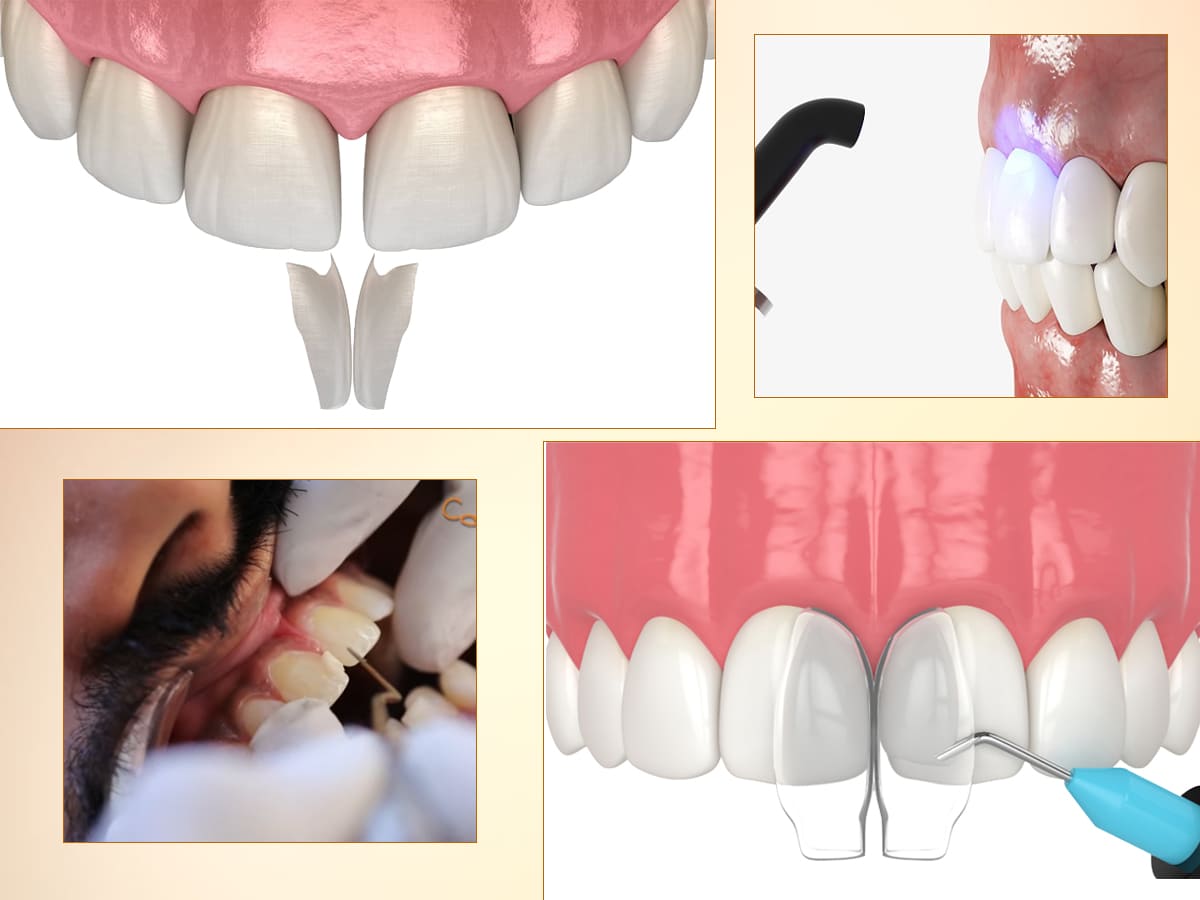 Is Dental Bonding an Affordable Cosmetic Dentistry Option?