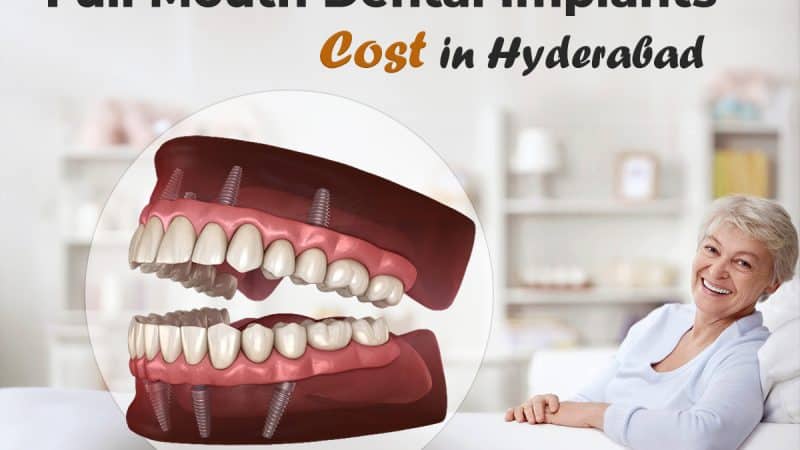 Full Mouth Dental Implants Cost in Hyderabad – Complete Price Breakdown by FMS Dental
