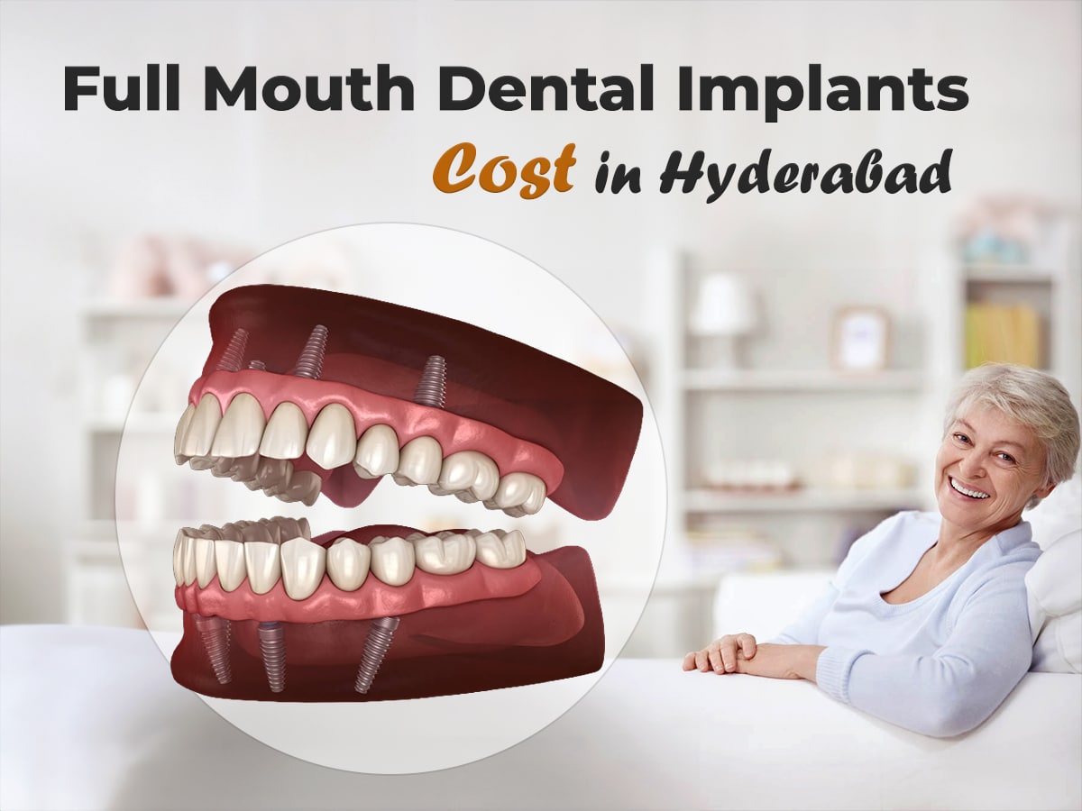 Full Mouth Dental Implants Cost in Hyderabad – Complete Price Breakdown by FMS Dental