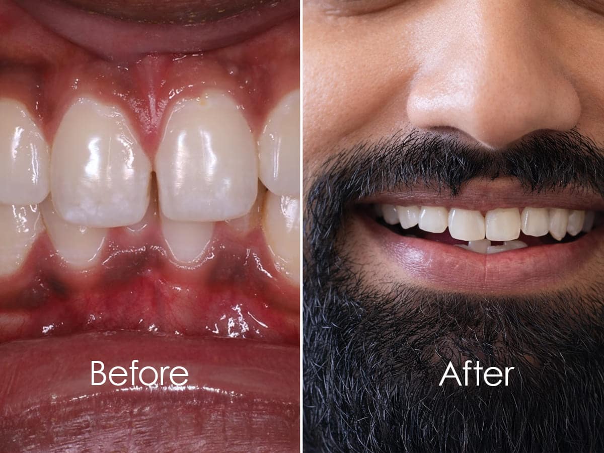 Is Dental Bonding an Affordable Cosmetic Dentistry Option