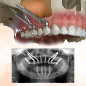 Zygomatic Implants for Extreme Bone Loss cases – A Graft-Less Path to Fixed Teeth