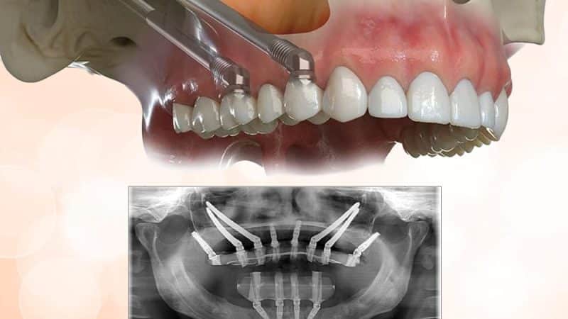 Zygomatic Implants for Extreme Bone Loss cases – A Graft-Less Path to Fixed Teeth