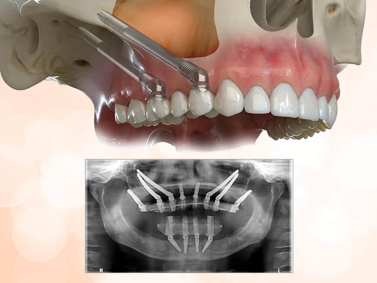 Zygomatic Implants for Extreme Bone Loss cases – A Graft-Less Path to Fixed Teeth