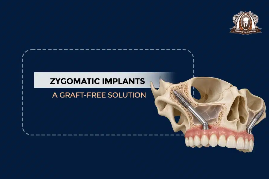 zygomatic implants