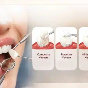 Cost of Dental Veneers: Treatment Options & Pricing Explained