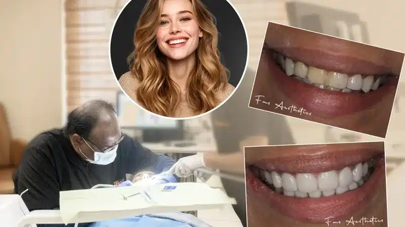 Smile Makeover Cost in Hyderabad, India