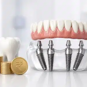 All-on-4 Dental Implants Cost in Hyderabad — FMS Dental