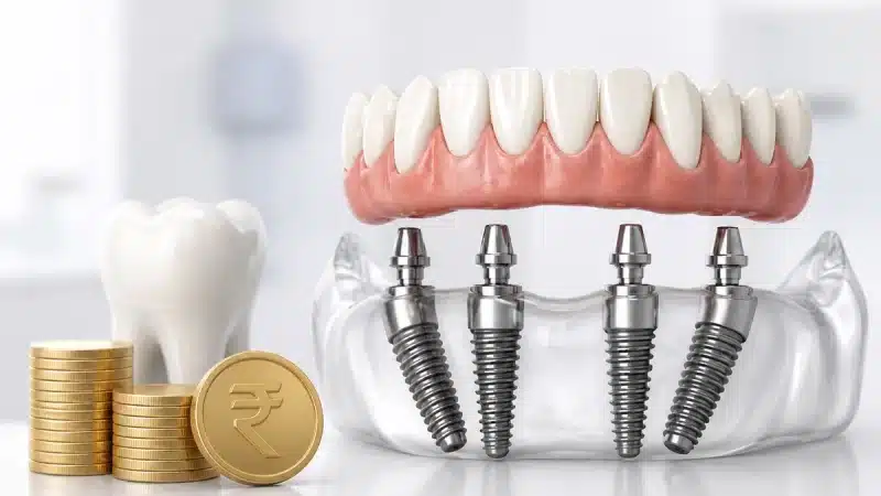 All-on-4 Dental Implants Cost in Hyderabad — FMS Dental