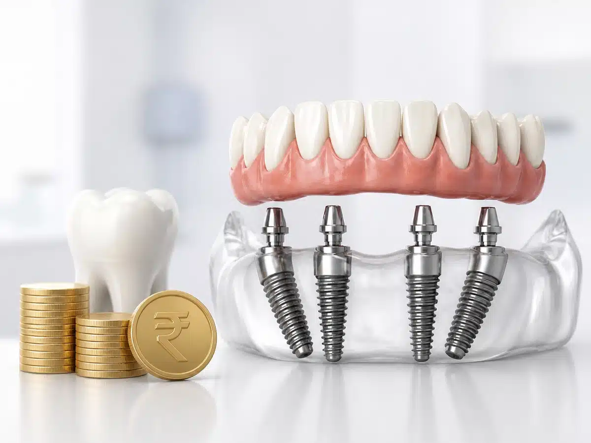 All-on-4 Dental Implants Cost in Hyderabad — FMS Dental