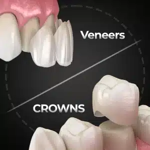 Are Dental Veneers Better Compared to Crowns? (Costs, Pros & Expert Guide 2026)