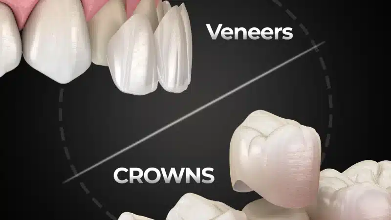 Are Dental Veneers Better Compared to Crowns? (Costs, Pros & Expert Guide 2026)