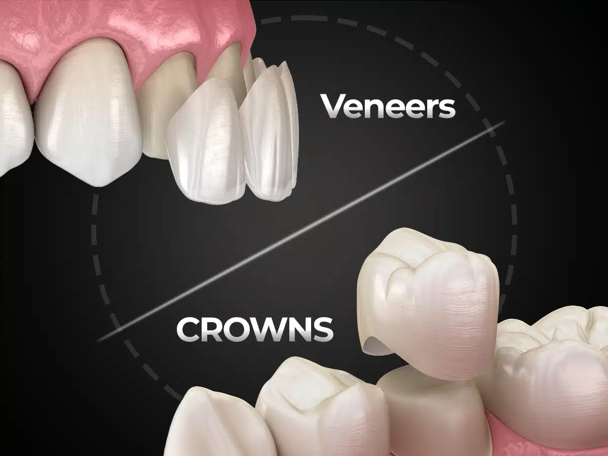Are Dental Veneers Better Compared to Crowns? (Costs, Pros & Expert Guide 2026)