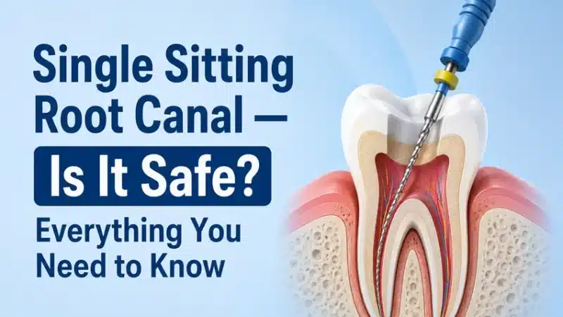 Single Sitting Root Canal — Is It Safe? Everything You Need to Know