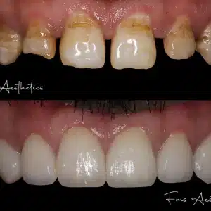 Teeth Gap Closure with Veneers