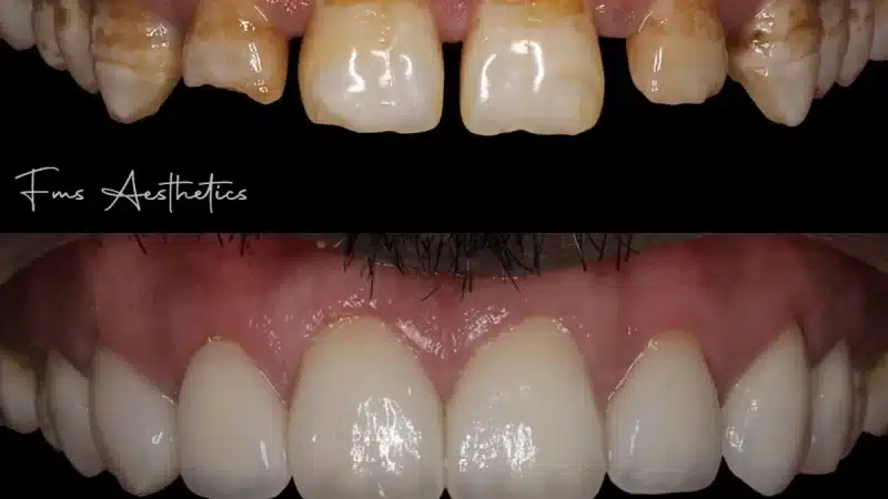 Teeth Gap Closure with Veneers