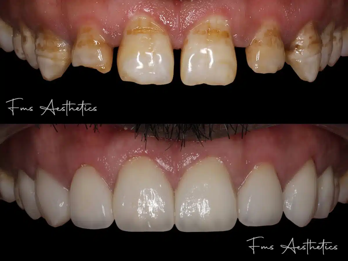 Teeth Gap Closure with Veneers