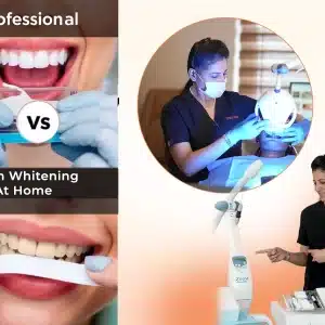 Teeth Whitening Cost & Treatment Comparison: Professional vs At-Home Bleaching