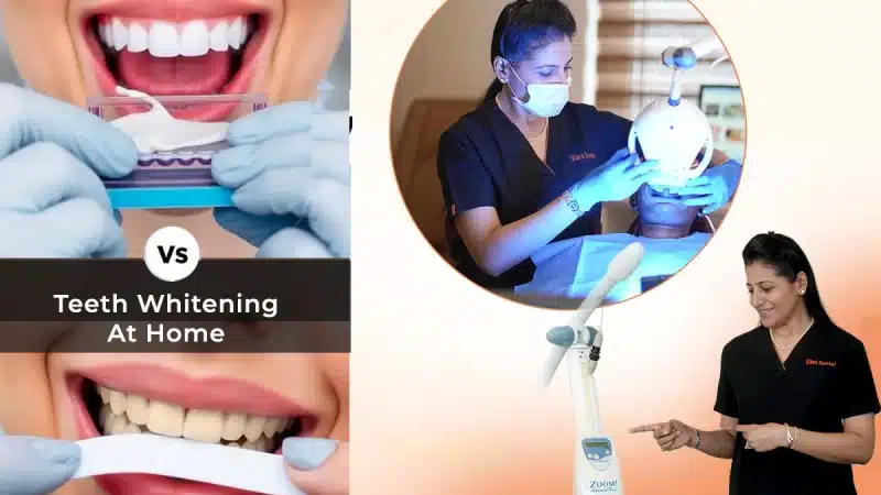 Teeth Whitening Cost & Treatment Comparison: Professional vs At-Home Bleaching
