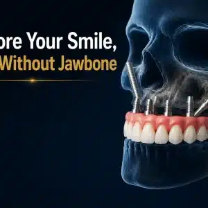 Zygomatic Dental Implants